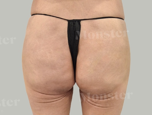 엉덩이필러 시술후